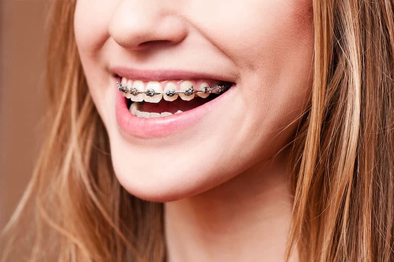 Patient with modern orthodontic treatment