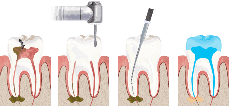 Modern root canal therapy procedure