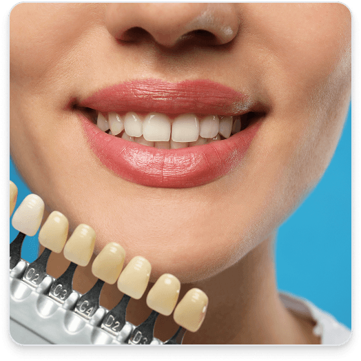 Take-Home Whitening