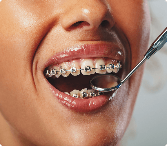 Free braces consultation with specialist