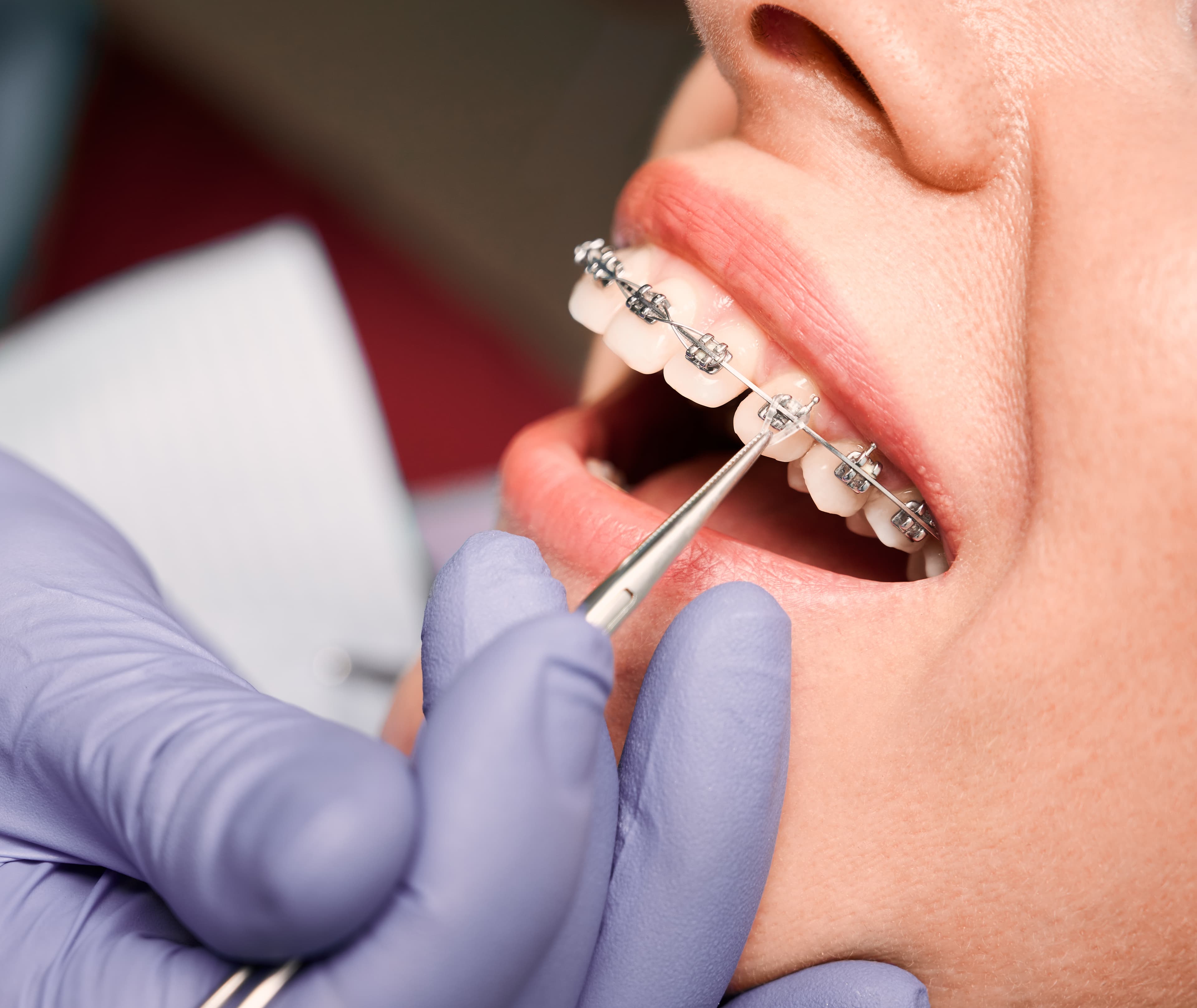 Brackets Metálicos
