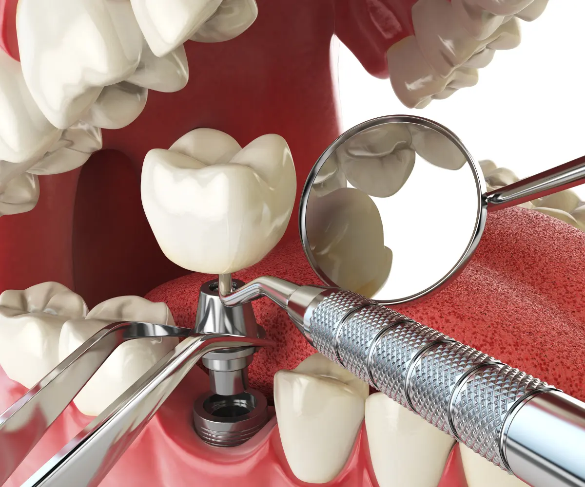 Dental implant cost consultation at Silver State Smiles in Las Vegas