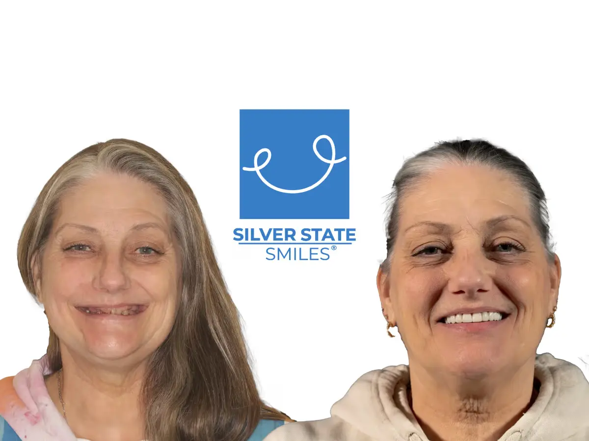 Silver State Smiles patient before and after fixed full-arch implant restoration, showing damaged and missing teeth on the left and a complete restored smile on the right
