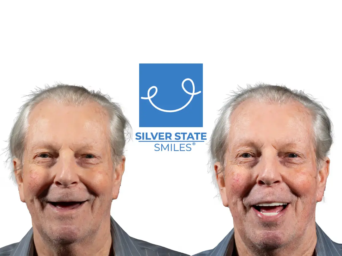 Before and after All-on-4 full-arch dental implants at Silver State Smiles Las Vegas, showing complete smile restoration with fixed implant-supported teeth