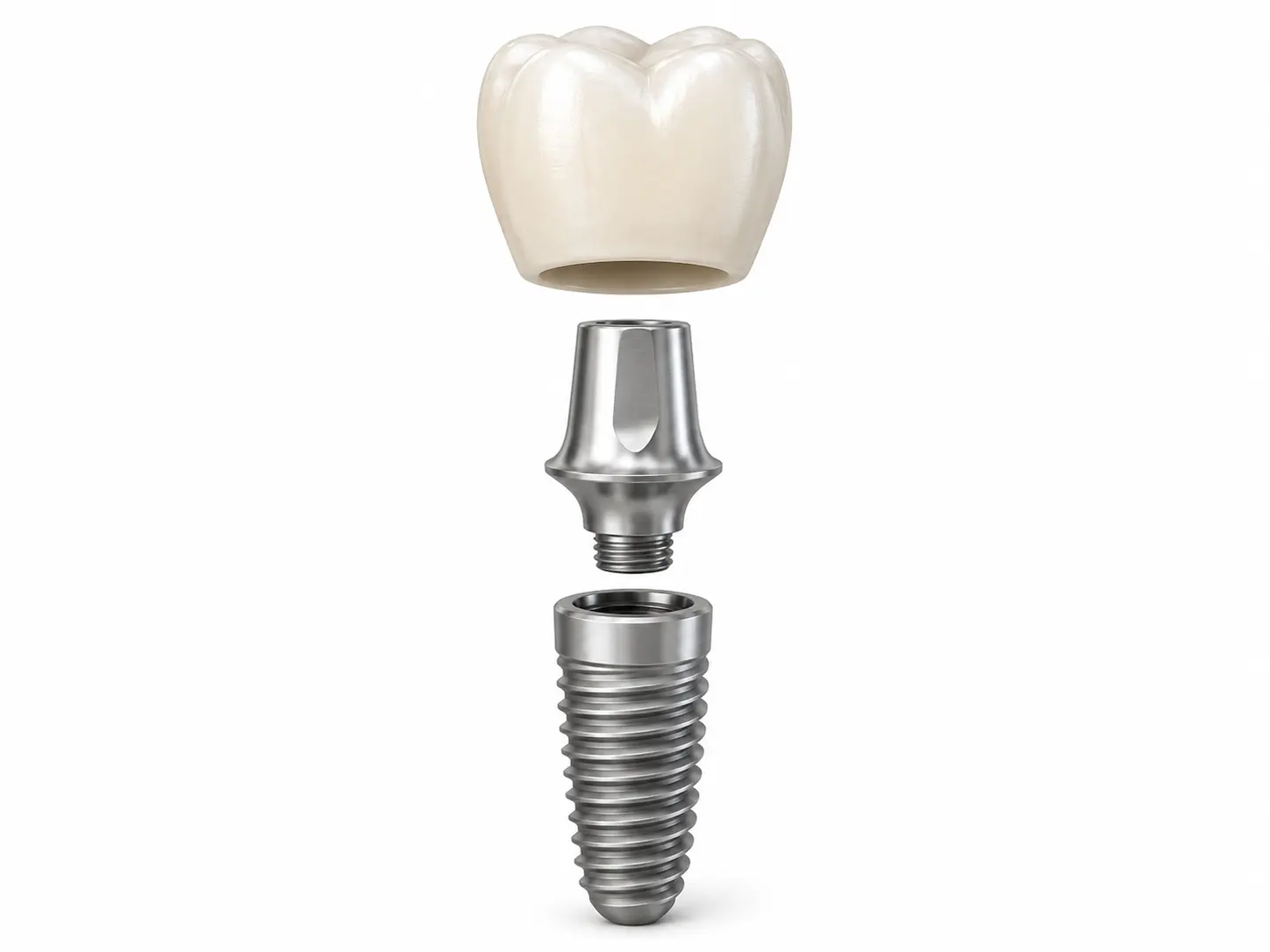 Diagram showing how All-on-4 implants are anchored to the jawbone