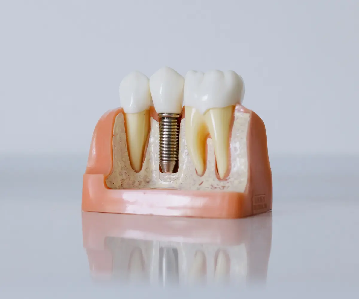 Cross-section dental implant model showing a titanium post embedded in a jaw model with surrounding teeth, on a reflective white surface