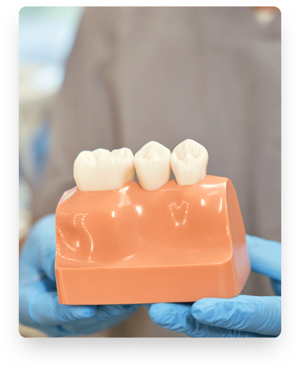 Forever Crown dental model