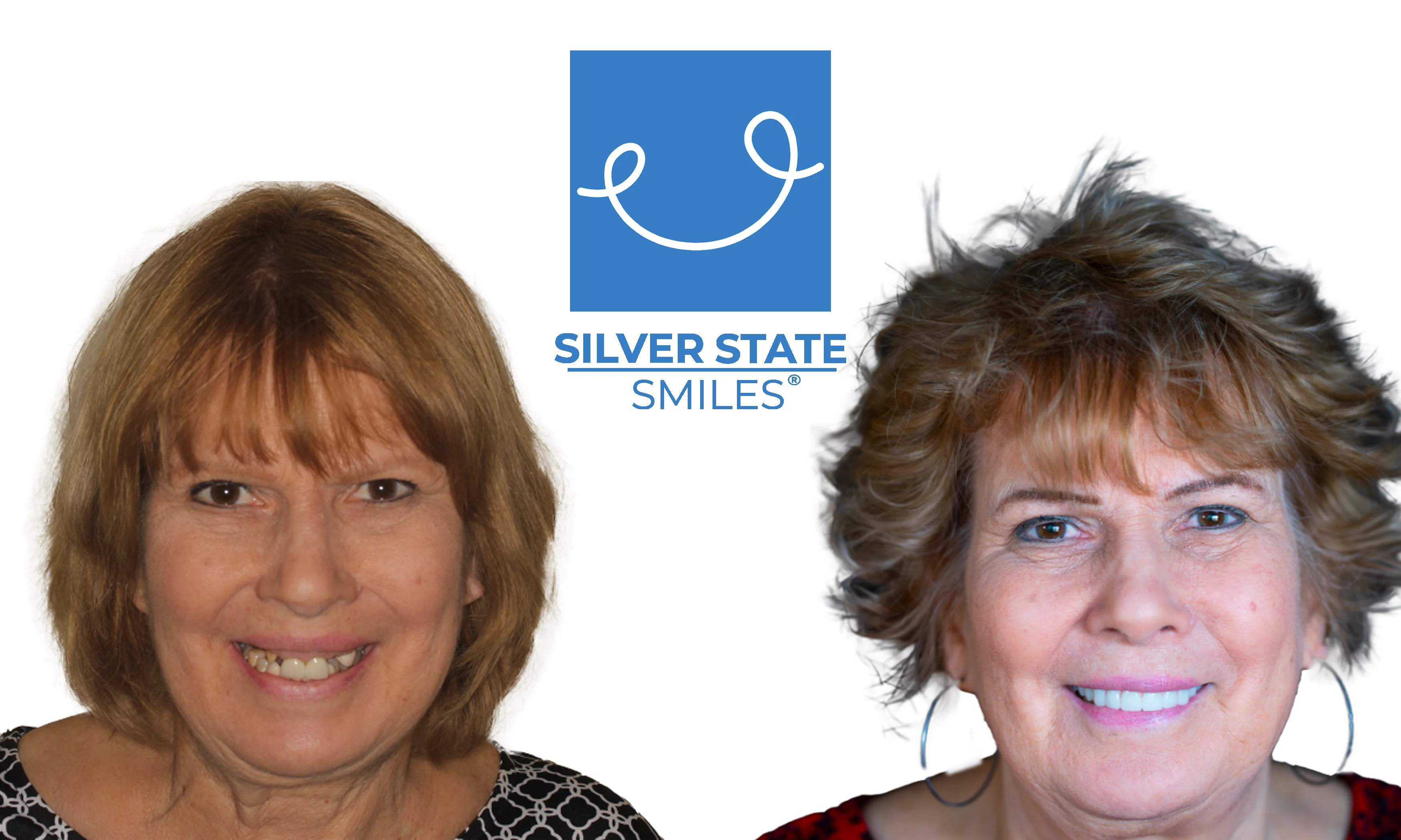 Patient smile transformation - Before and after dental treatment