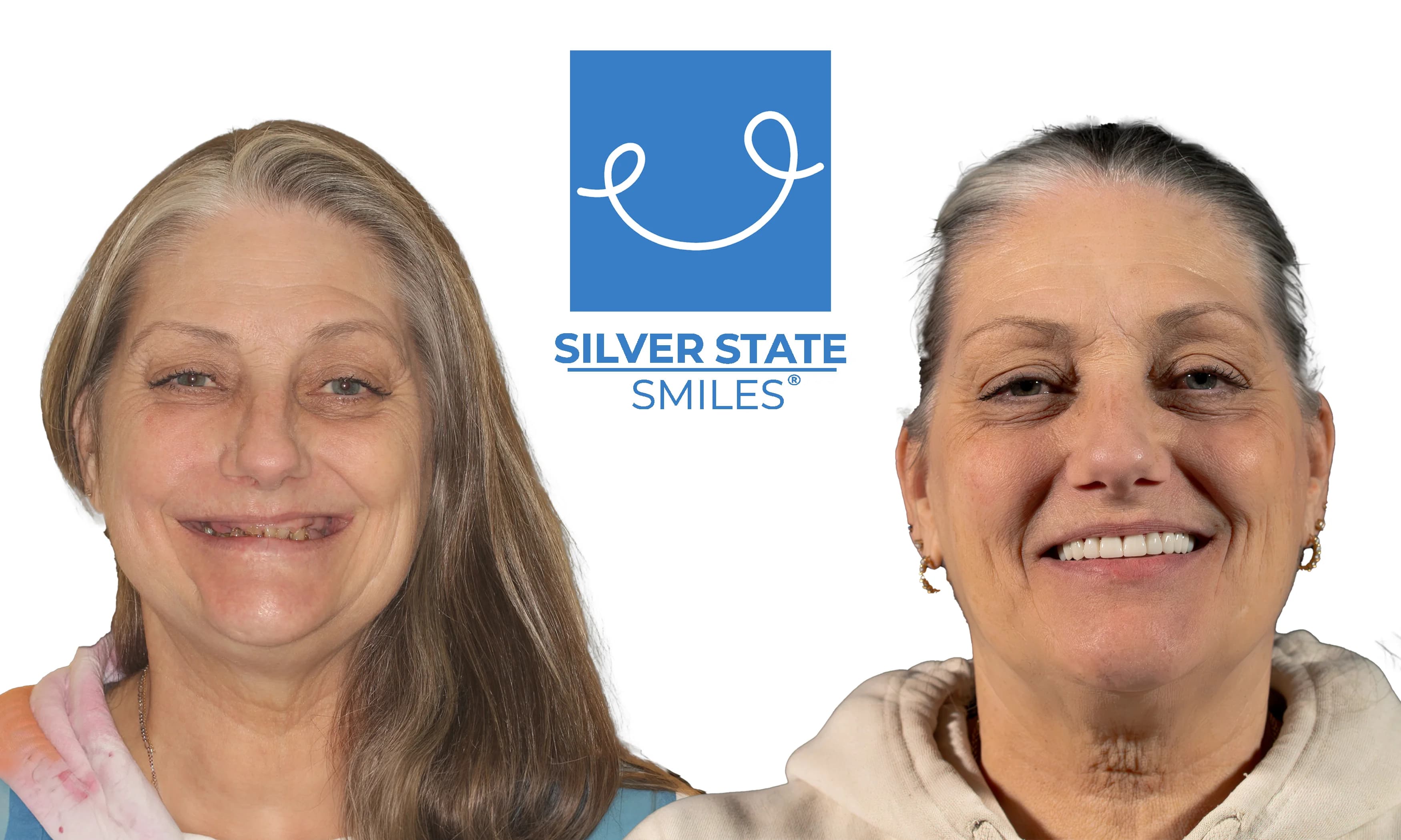 Patient smile transformation - Before and after dental treatment
