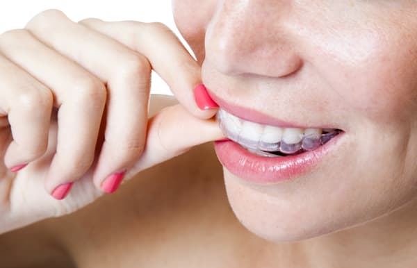 Beautiful smile with Invisalign clear aligners