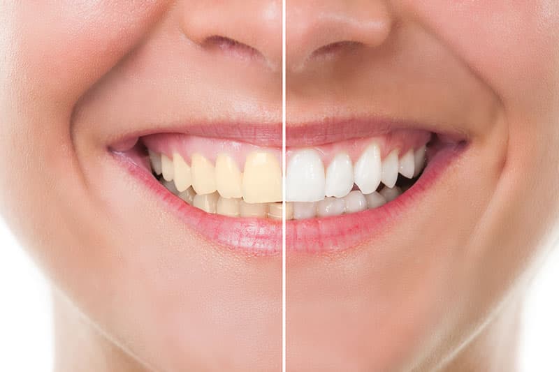 Resultados de blanqueamiento dental