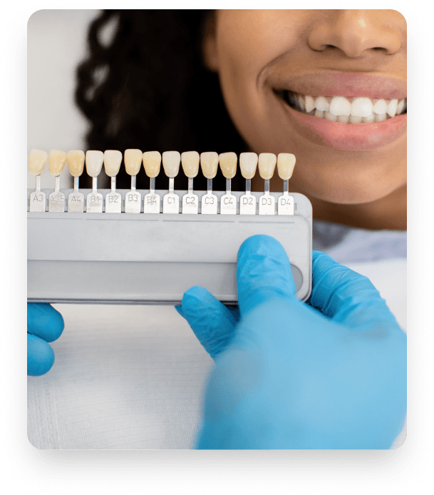 Veneers showcase